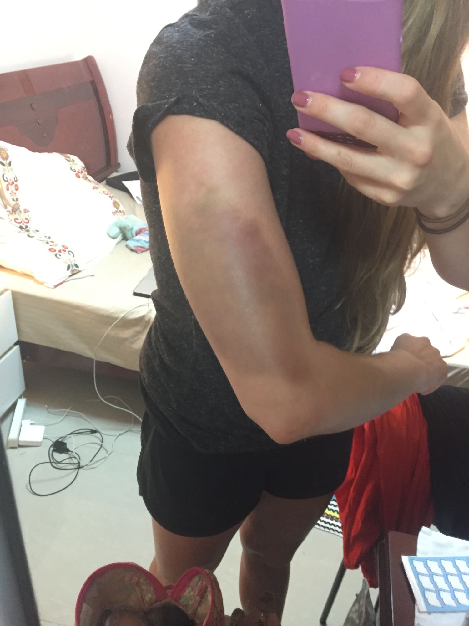 My Experience with Chinese Cupping & Scraping (TCM) in China!